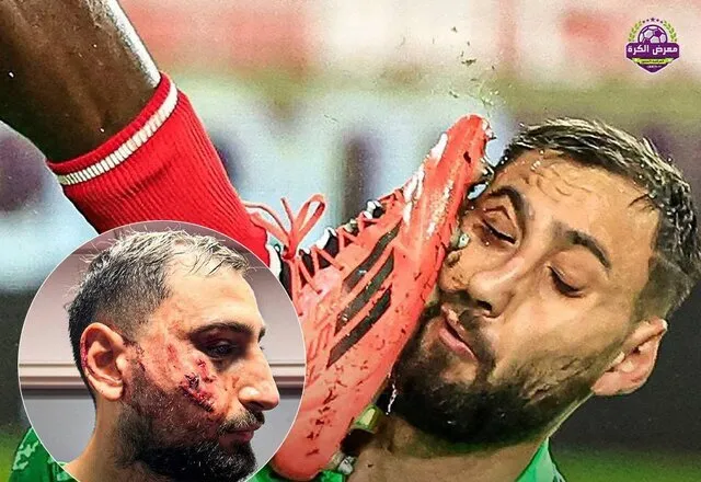 مصدومیت شدید دوناروما